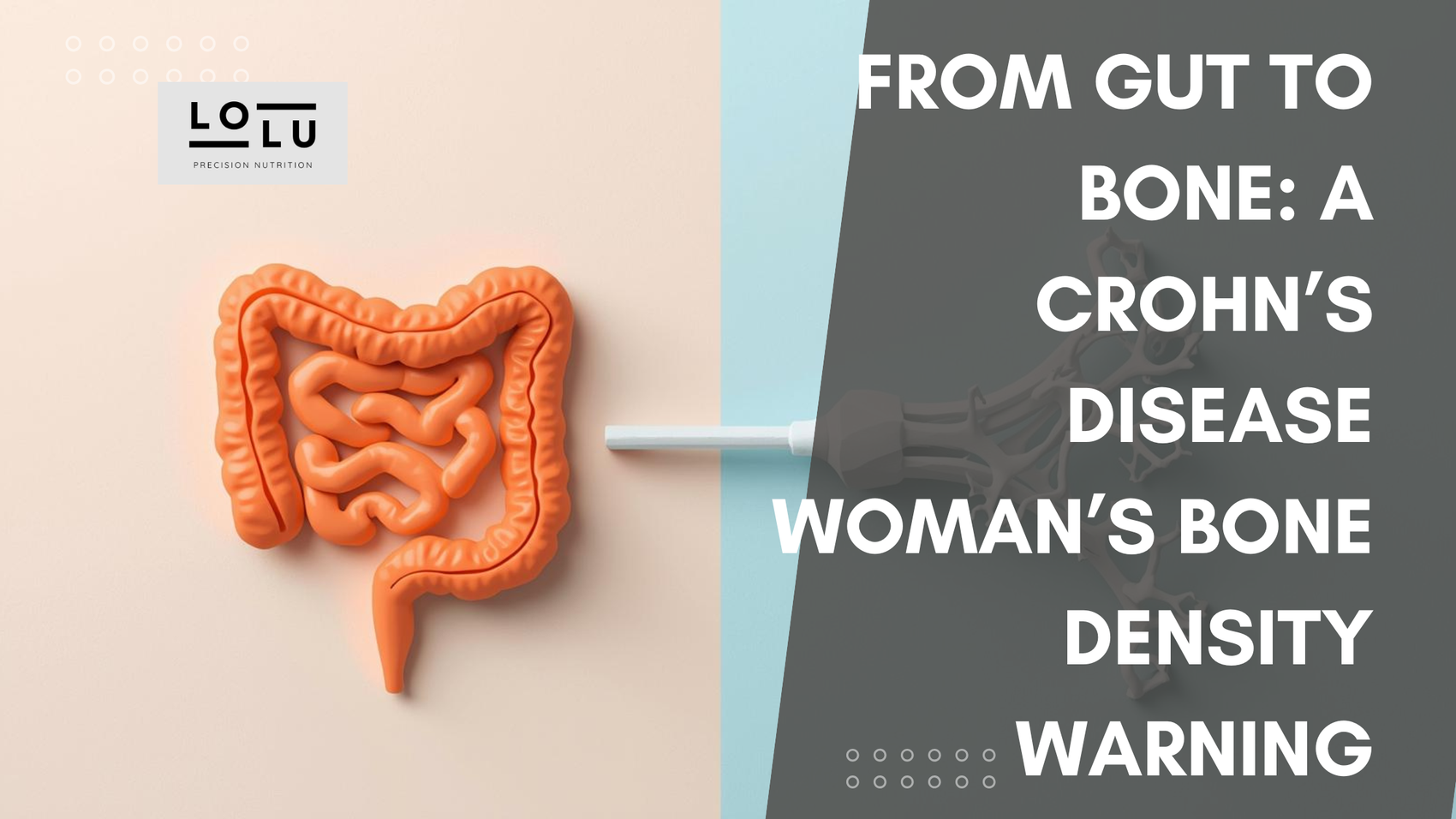 From Gut to Bone: A Crohn’s Disease Woman’s Bone Density Warning